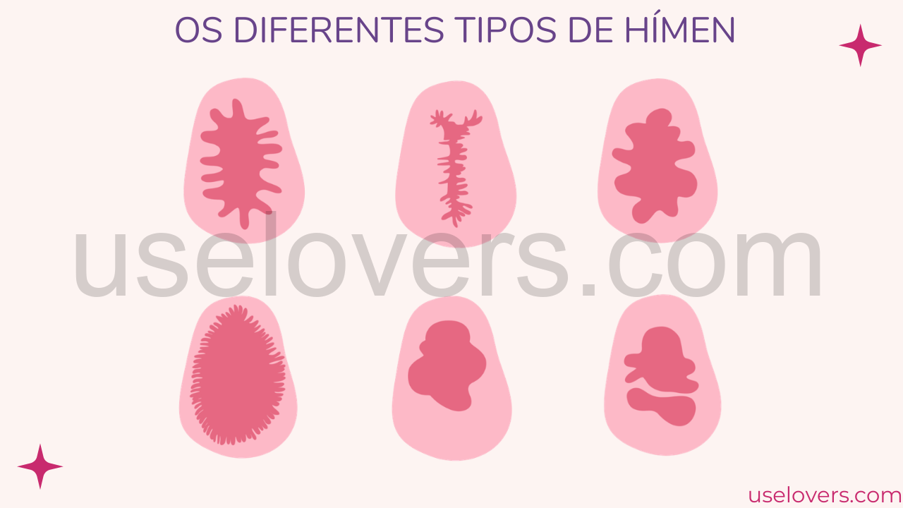 Imagem com difrentes tipos de hímen